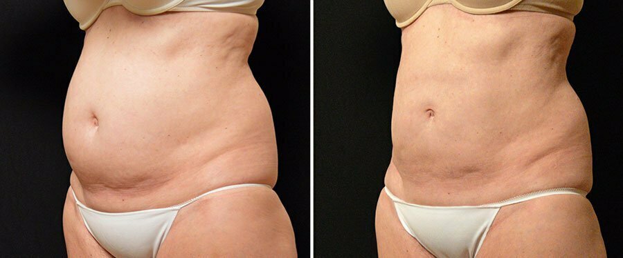 Atlanta CoolSculpting Cost Swan Center For Plastic Surgery